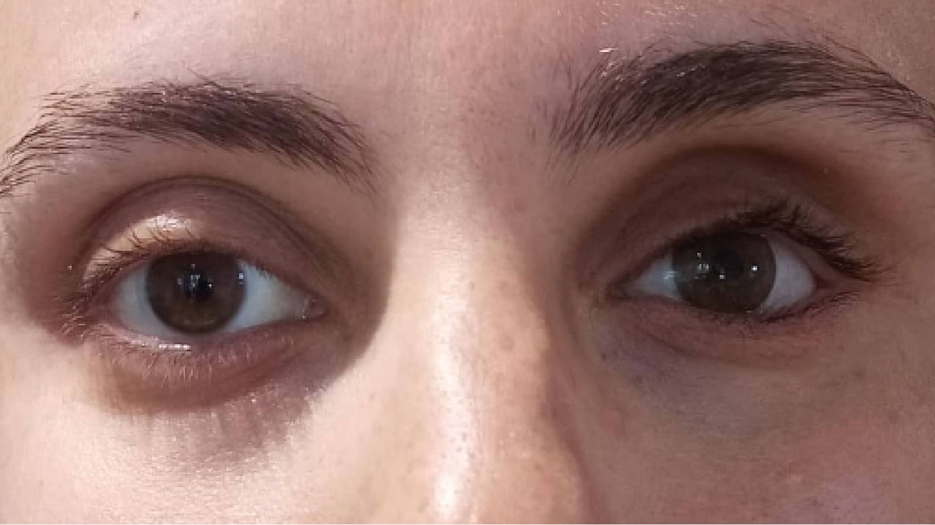 Realizzazione di protesi oculare per una ragazza con occhi marroni
