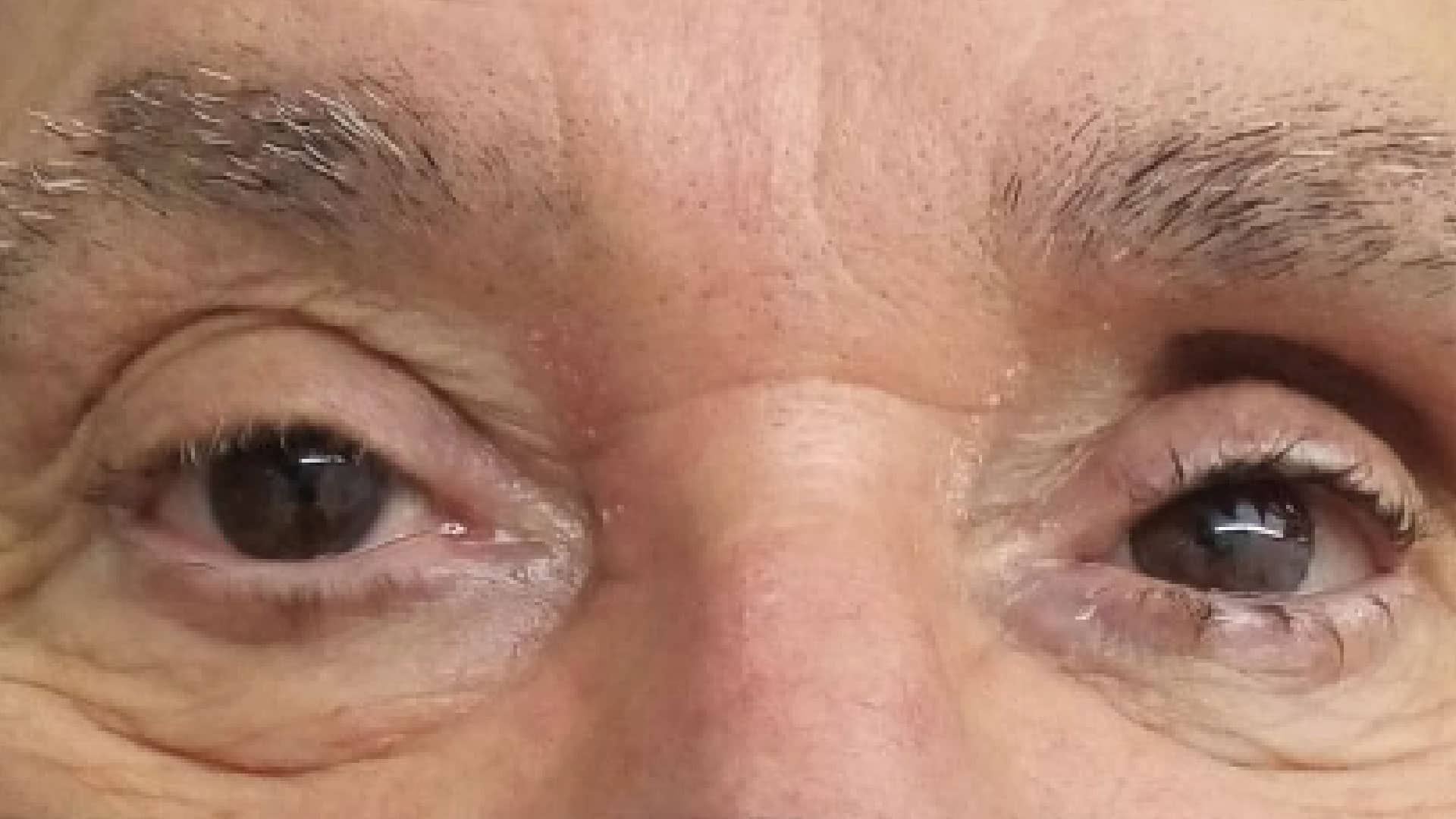 Realizzazione di una protesi oculare per un signore con occhi marroni
