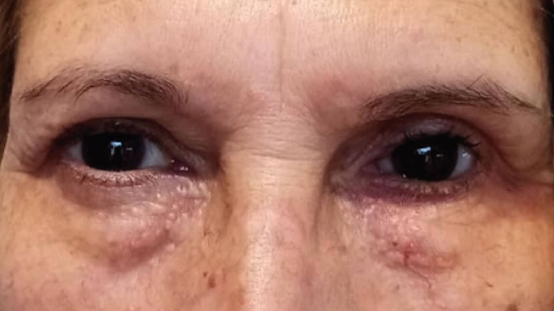Realizzazione di una protesi oculare per una donna con occhi marroni