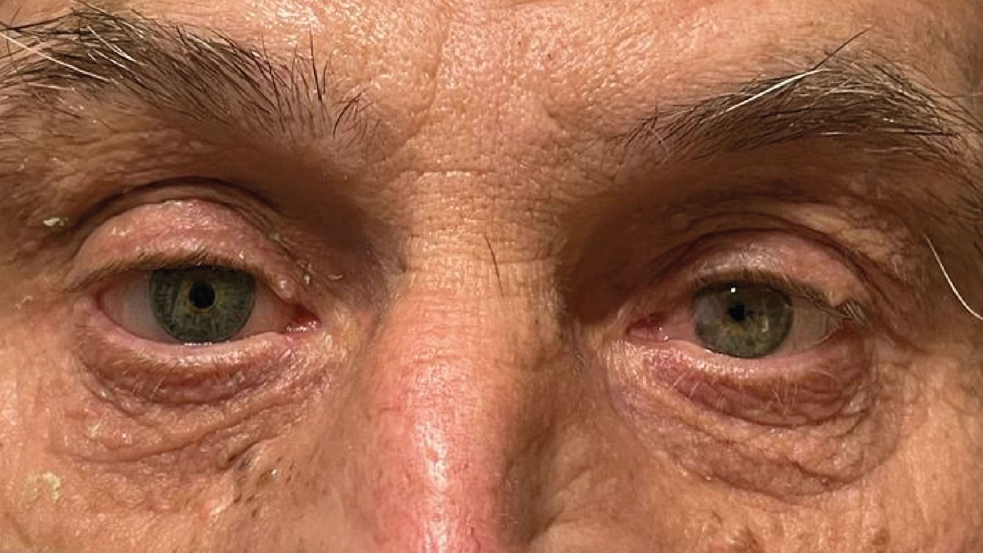 Realizzazione protesi oculare per un signore con occhi verdi