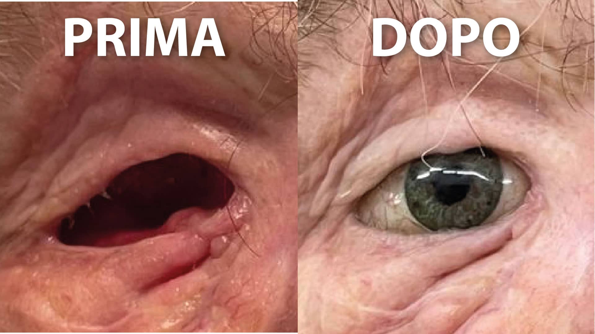 Cavità oculare prima e dopo la realizzazione della nostra protesi